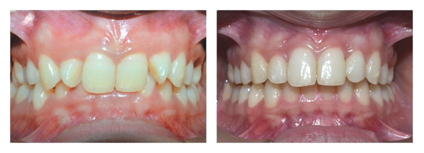 Before After