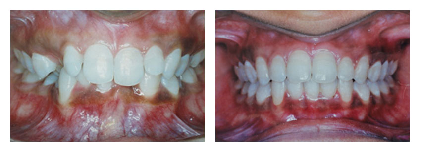 Before After