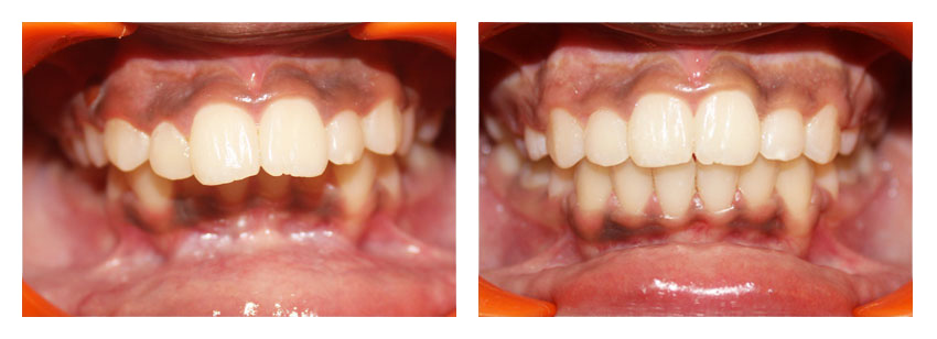 Before After