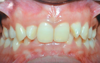 Overbite/Deep Bite