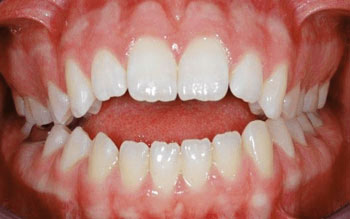 Open Bite