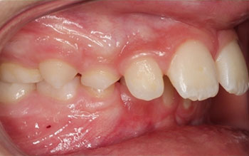 Overjet/Proclination