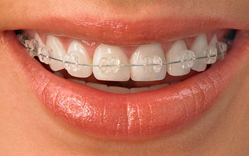 Ceramic Braces