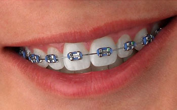Metal Braces