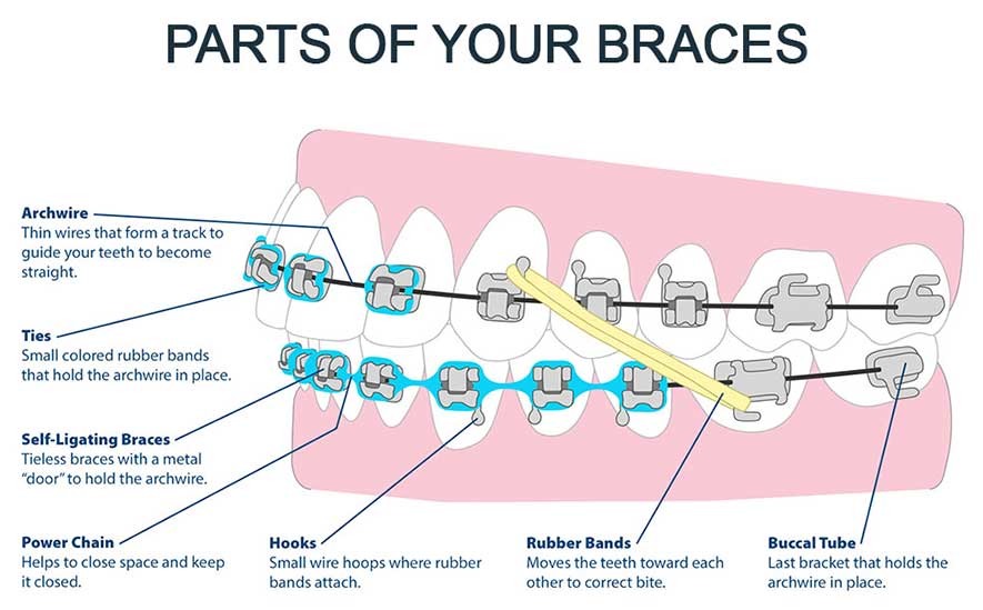 Parts Braces