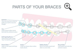 Part of your Braces