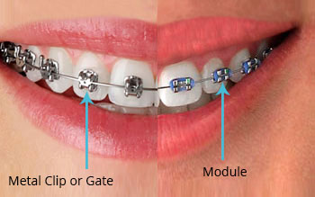 Self-Ligating  Braces