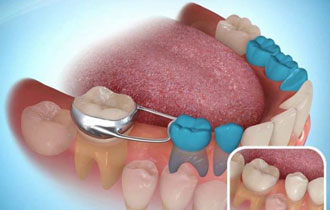 Removal Ortho