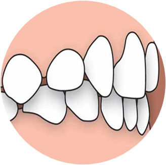 Backwardly Placed Teeth