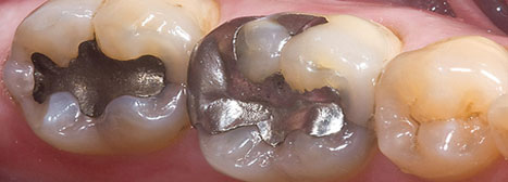 Amalgam