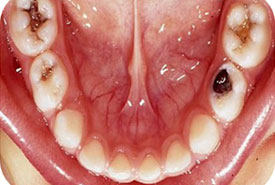 Root Canal