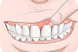 Root Canal