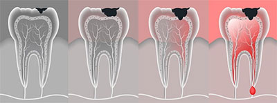 Root Canal