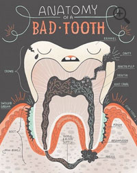 Root Canal