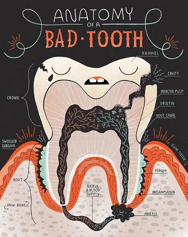 Root Canal