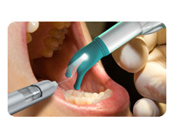 Root Canal