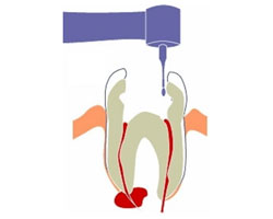 Root Canal
