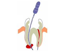 Root Canal