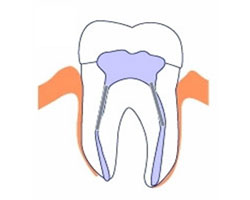 Root Canal
