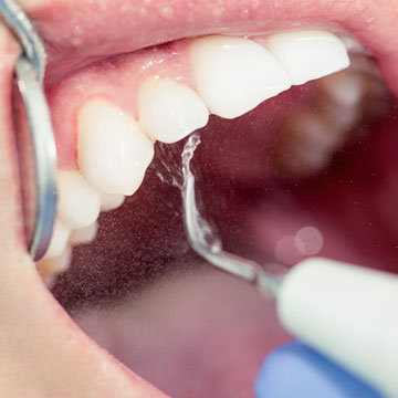 Tooth Cleaning